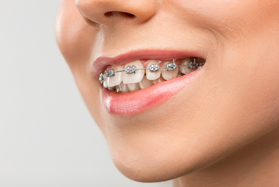 Requirements for Braces – Do I Need a Brace?