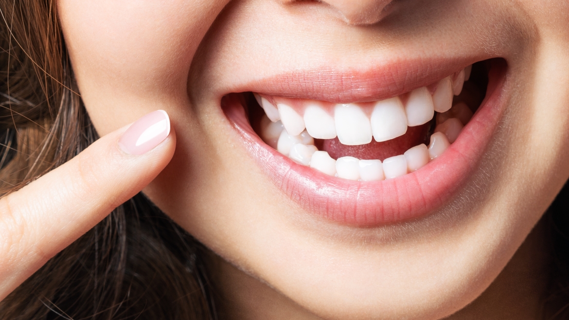 Do Veneers Damage Teeth?