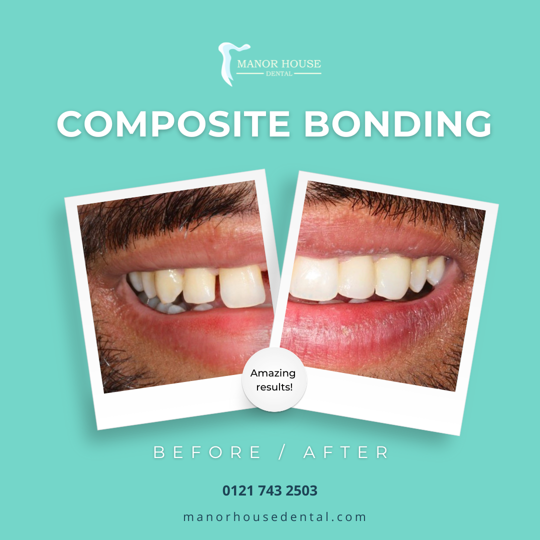 composite bonding infographic manor house dental