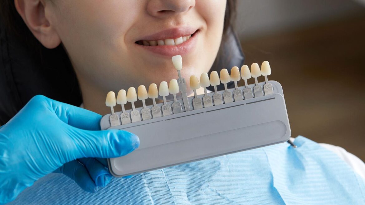 How Much Does Dental Veneers Cost?