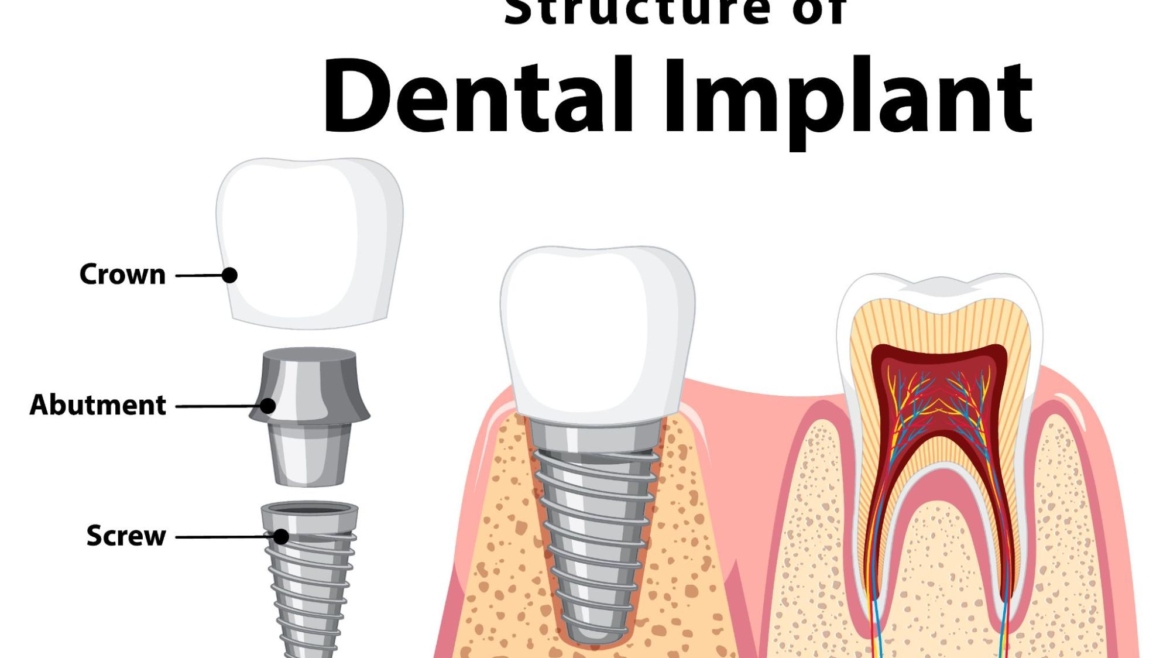 What Is a Dental Implant Abutment?