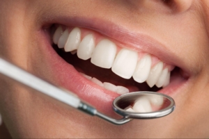 composite bonding