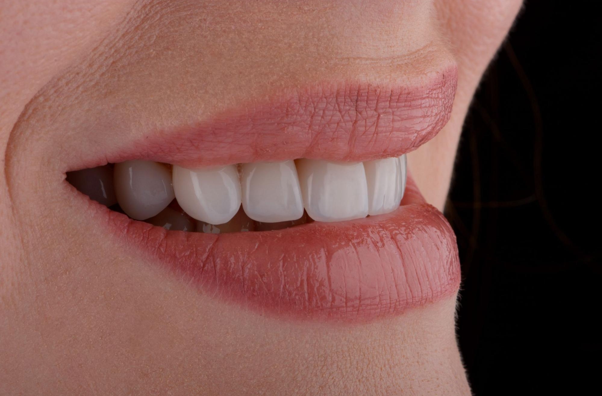 How Painful Is Composite Bonding? A Dentist Birmingham Explains
