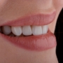 How Painful Is Composite Bonding? A Dentist Birmingham Explains
