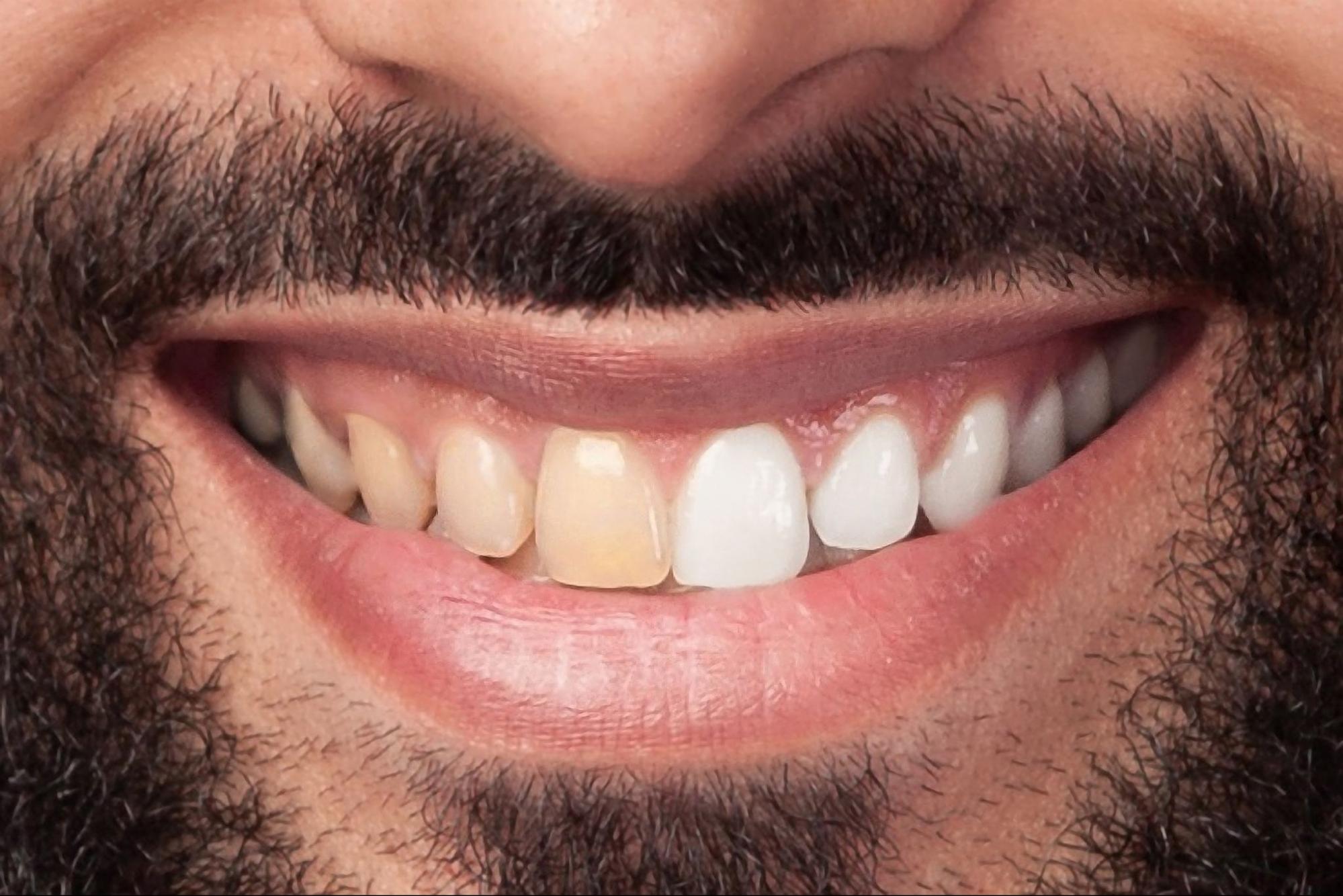 Birmingham composite bonding