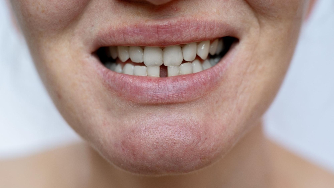 Composite Bonding vs Braces: Which Is Better for Minor Gaps?