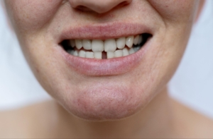 composite bonding teeth Birmingham