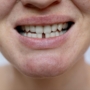 Composite Bonding vs Braces: Which Is Better for Minor Gaps?