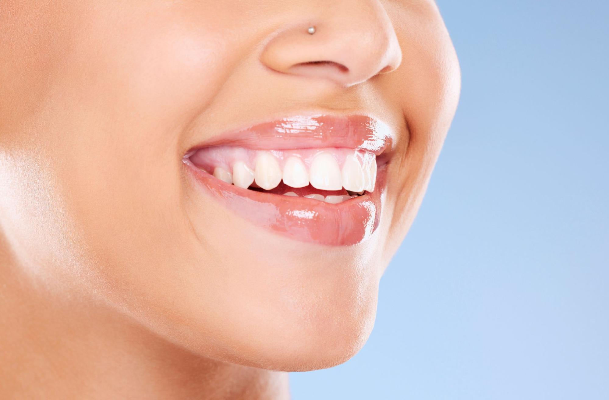 composite bonding teeth Birmingham